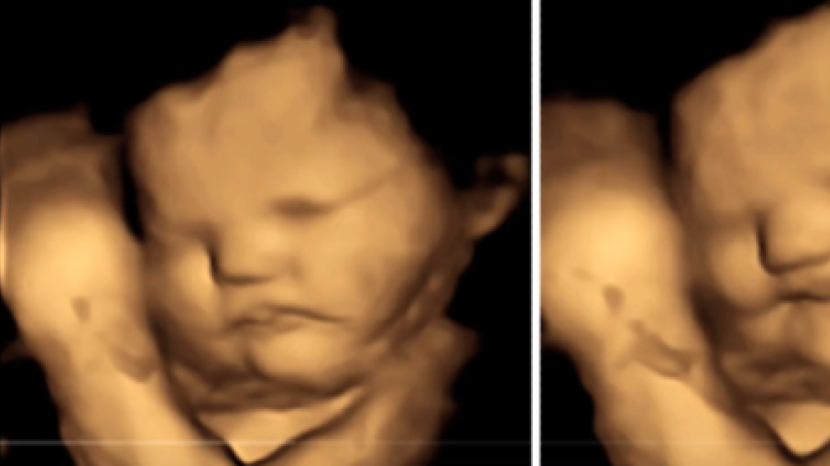 子宮嬰兒有沒有生命?3D超聲波圖片揭開秘密